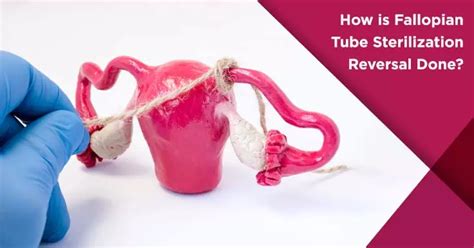 Revolutionary Technique to Permanently Stop Unwanted Pregnancies: Sterilization of Fallopian Tubes